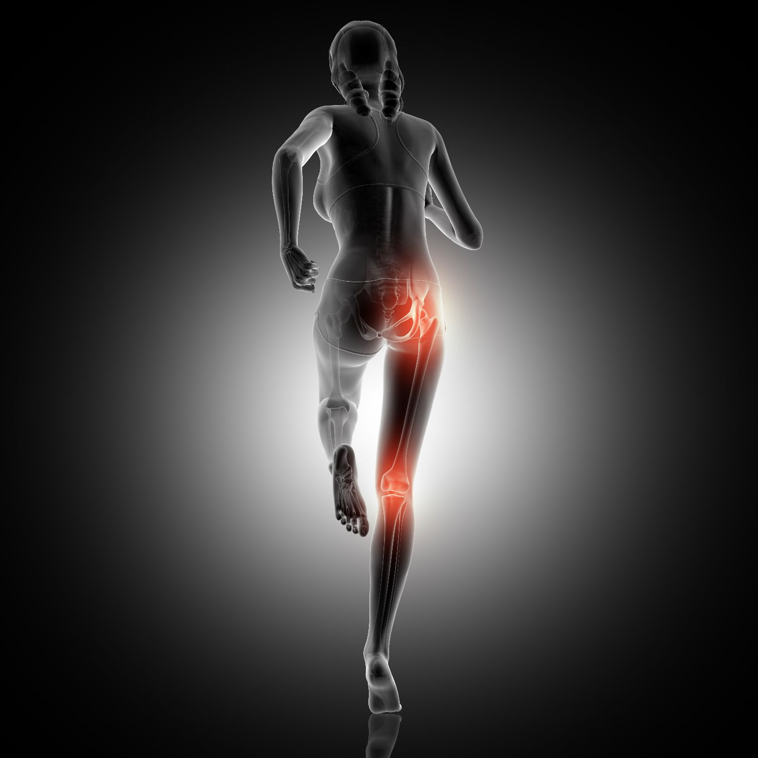 Sciatica