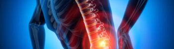 Fisioterapia ernia del disco