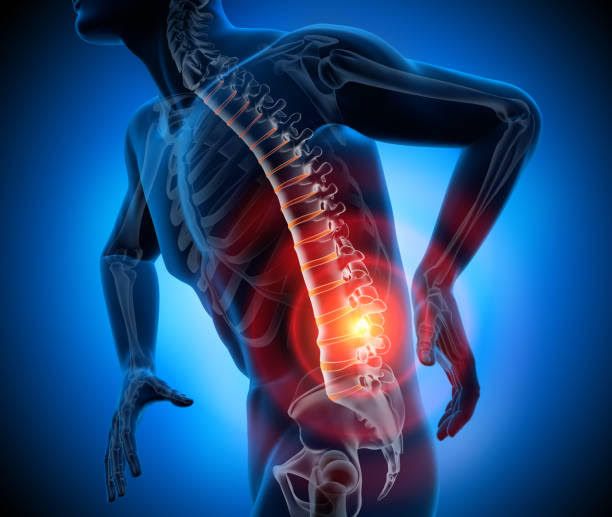 Fisioterapia ernia del disco